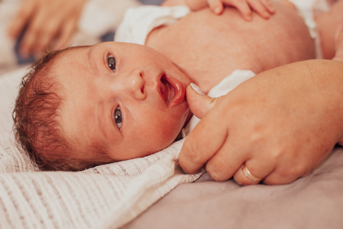 baby with lip or tongue tie 